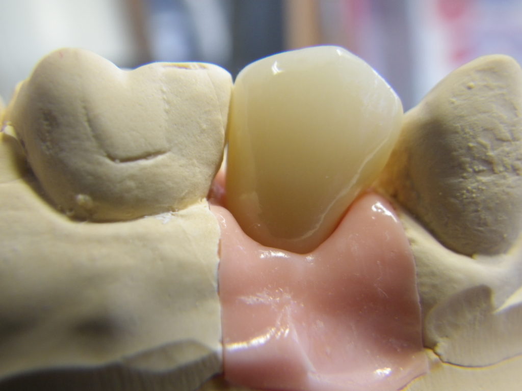 技工所から届いて上部構造です。シリコンガム模型といって歯茎の部分をシリコンゴムで製作し、歯茎をより実際の口の中に近い状態に設定し技工物を制作します。こうすることで、歯茎からの立ち上がりをより自然に製作可能となります。