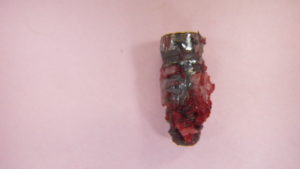 除去したインプラント