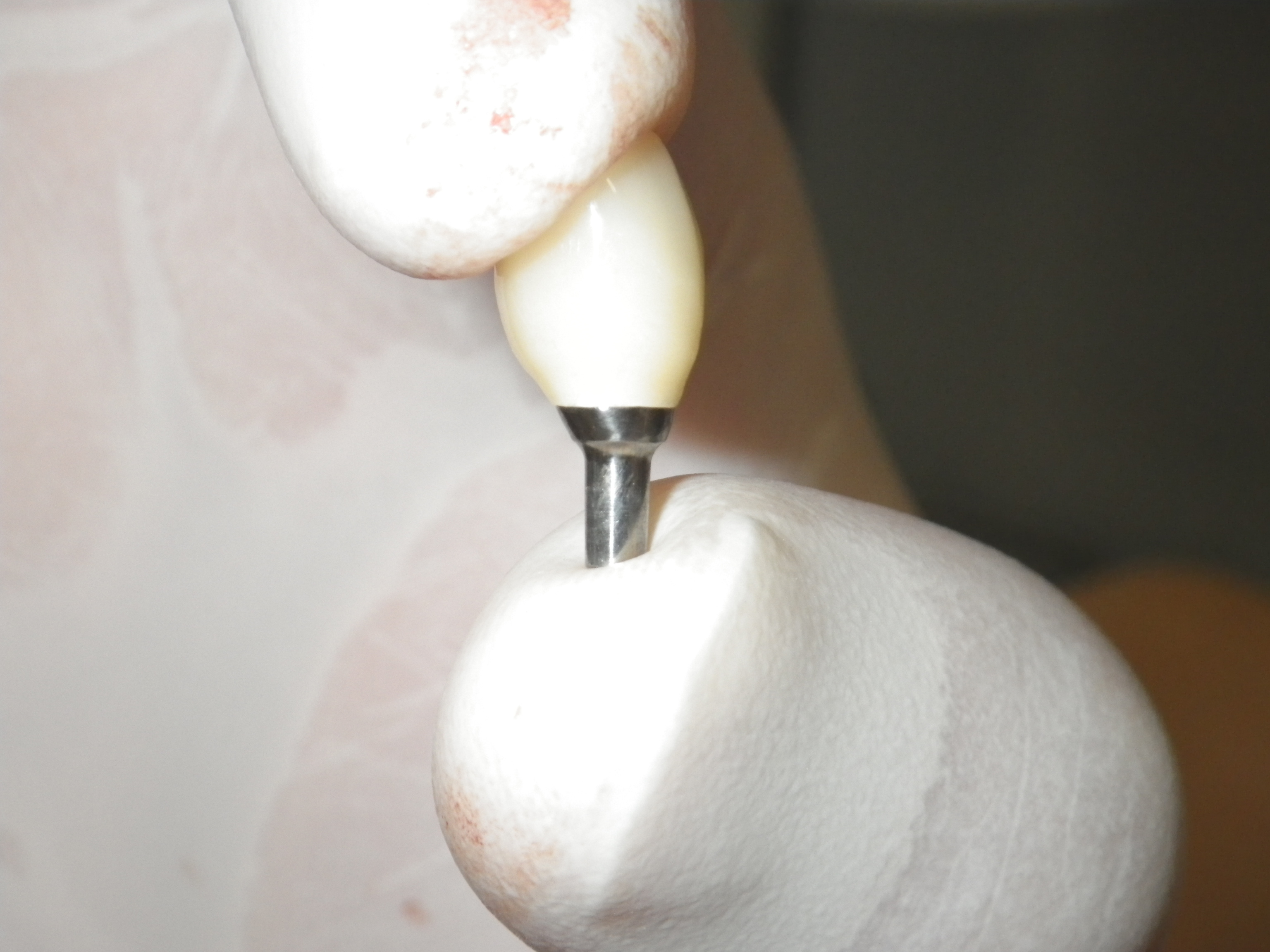 ネジを使わないBiconインプラント