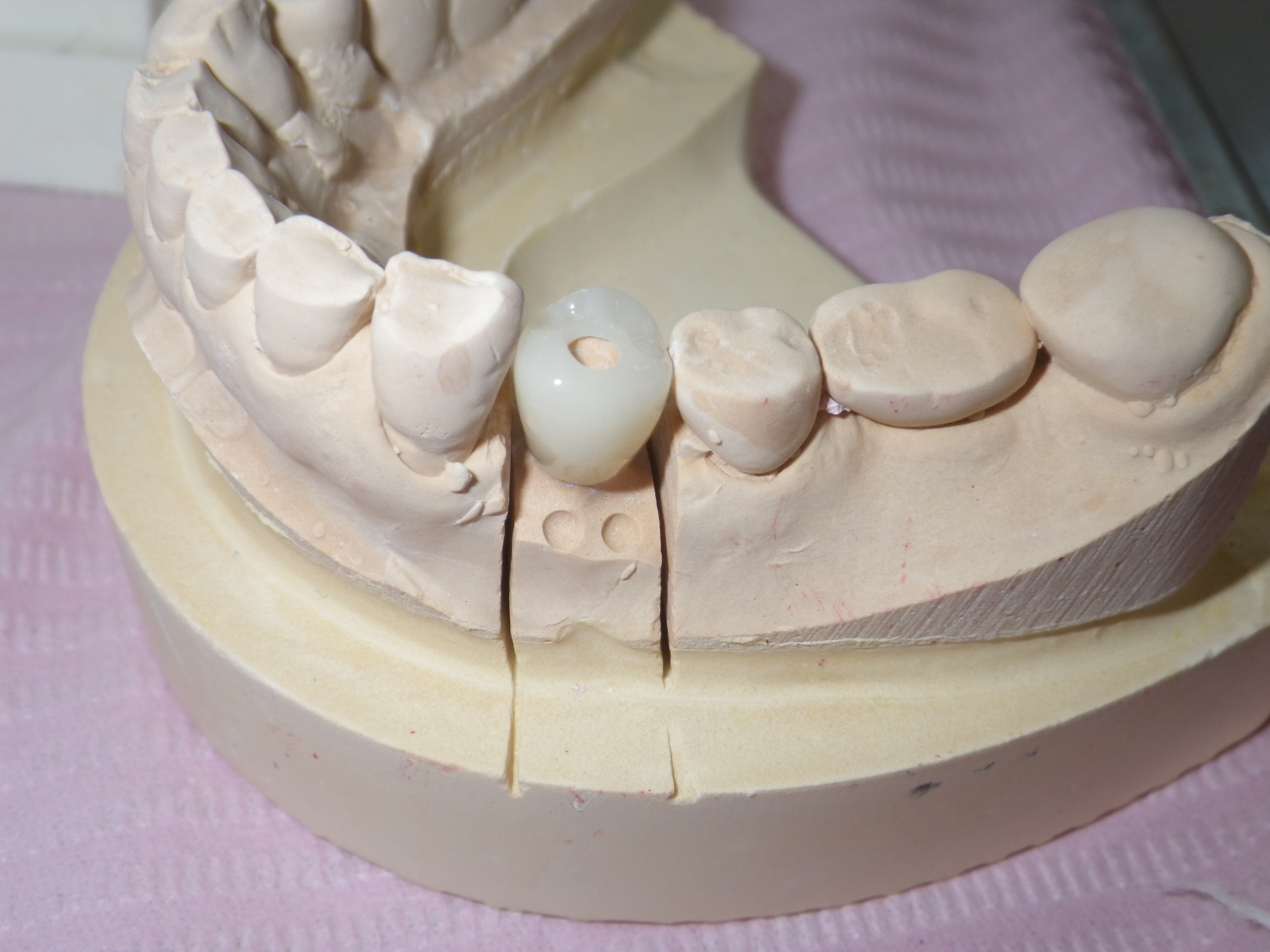 フルジルコニアクラウン,上部構造
