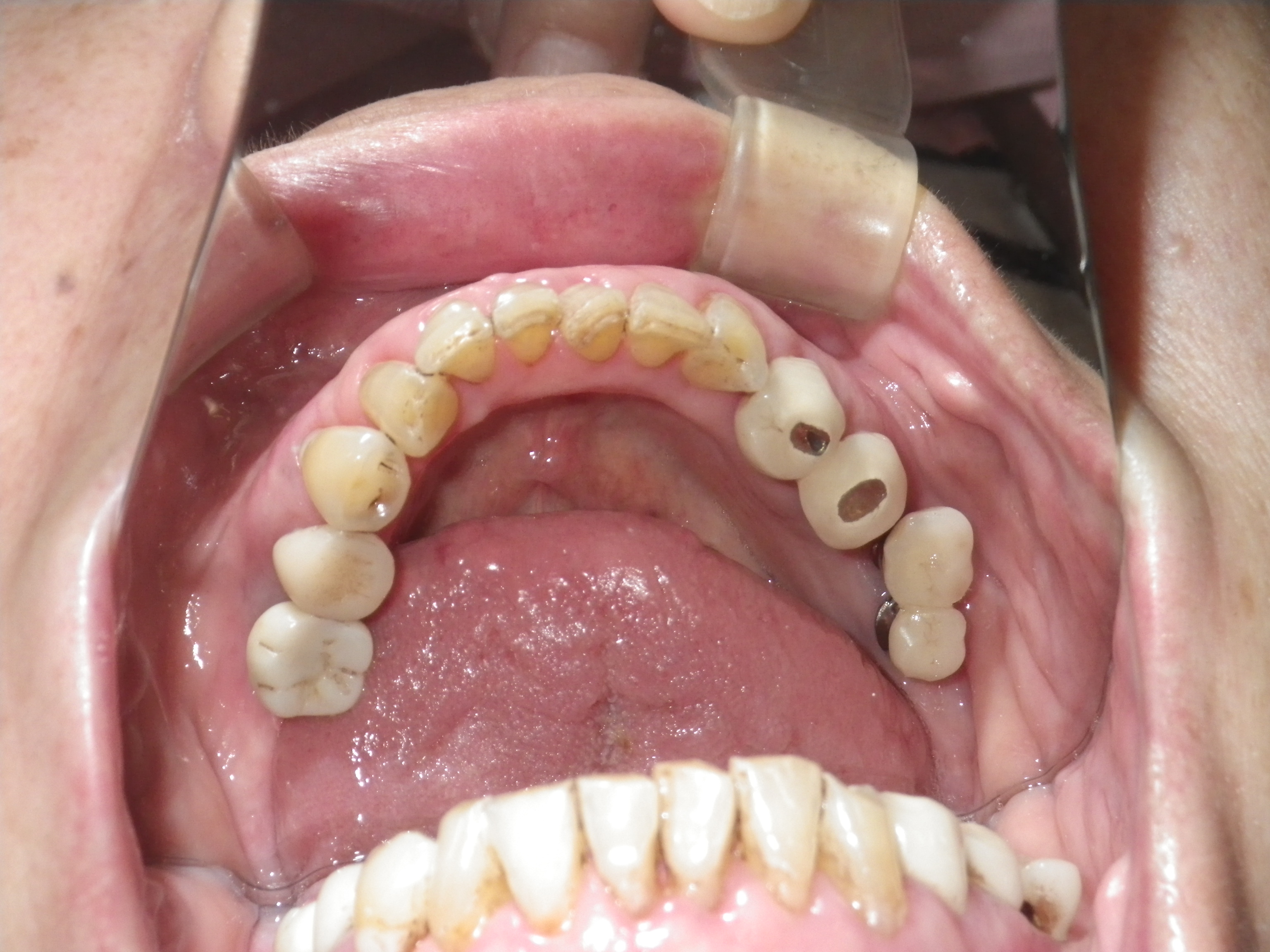 インプラントが移動する。重度の歯周病。