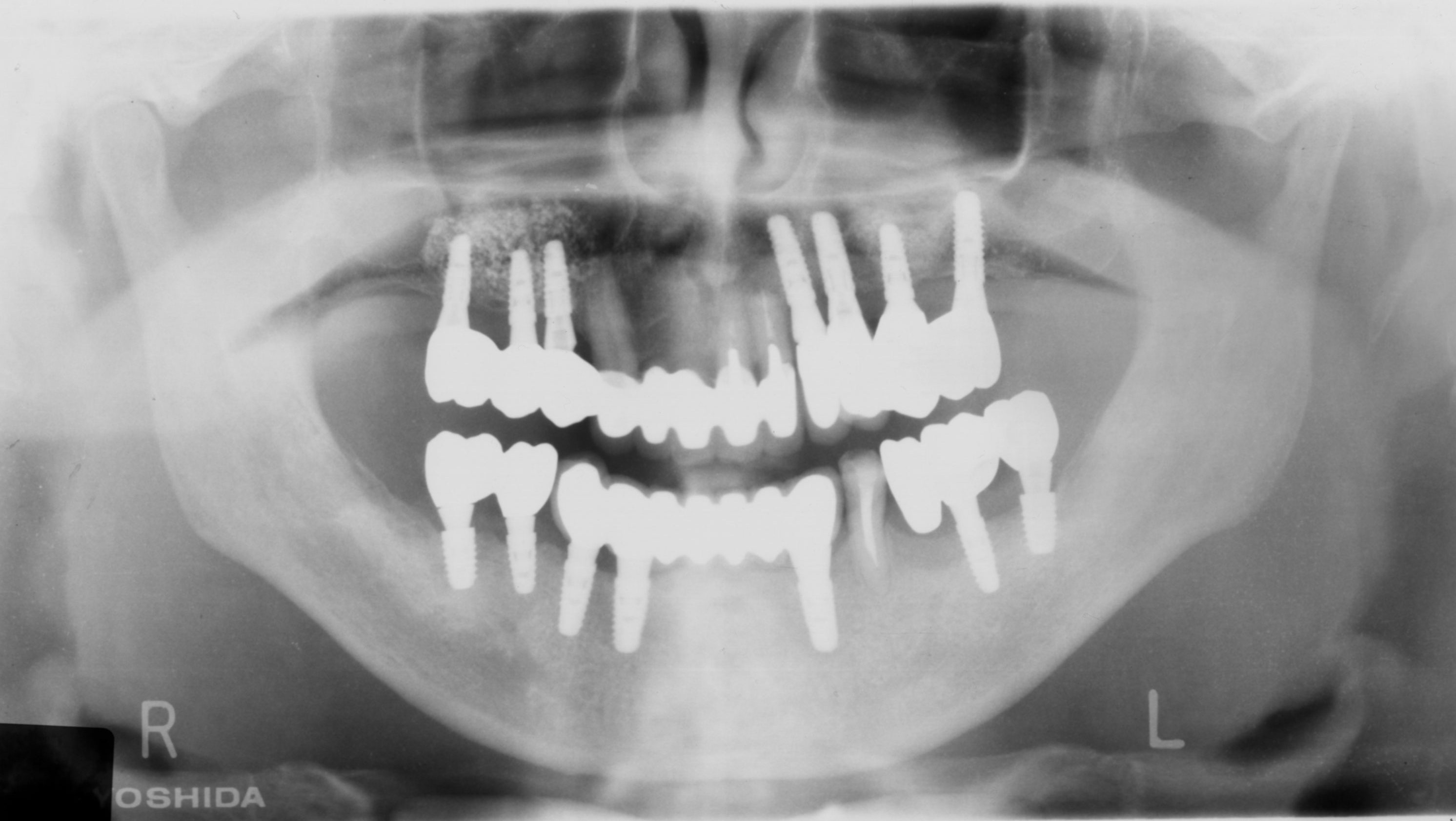 重度歯周病患者のインプラント治療