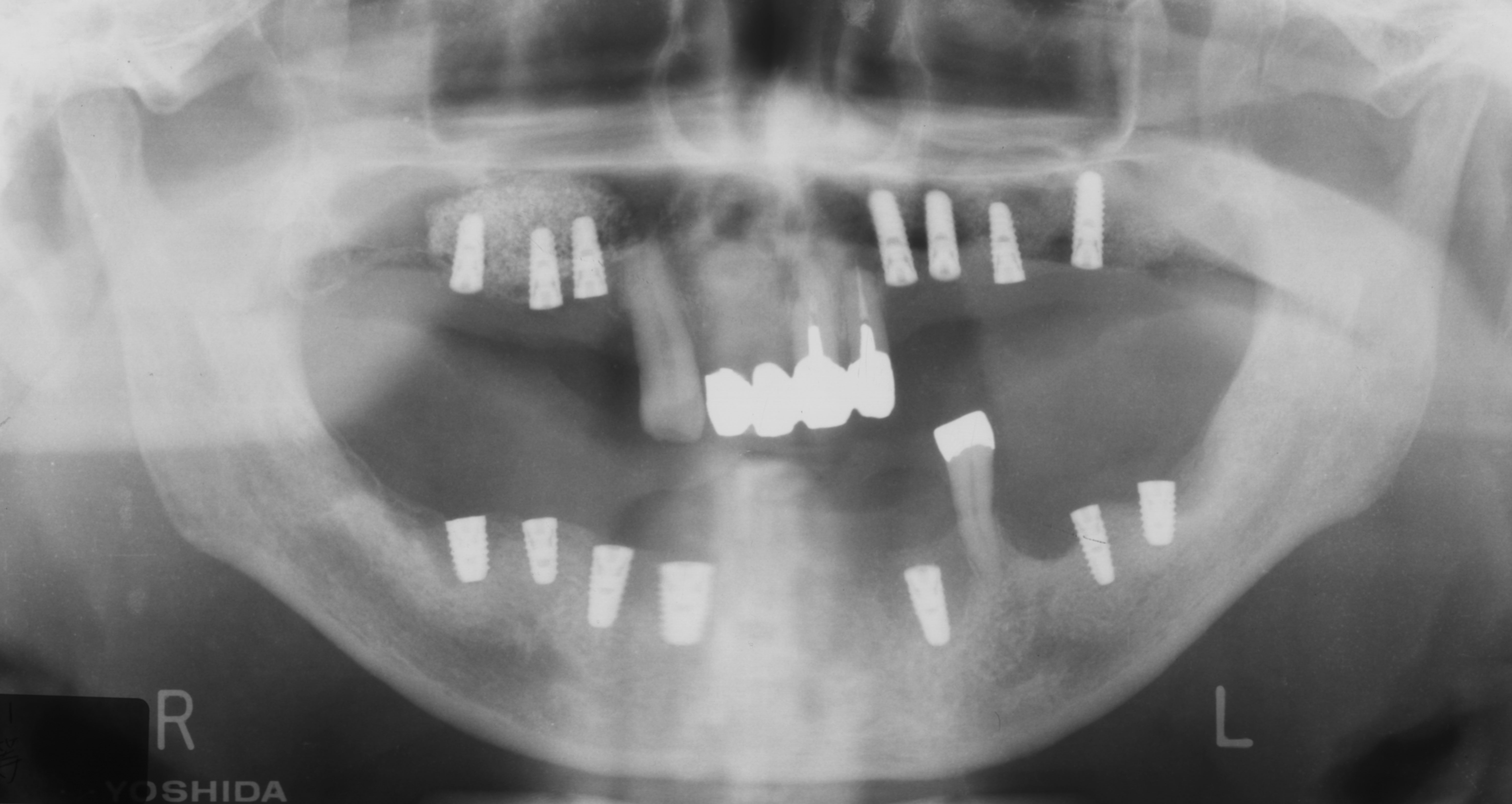 サイナスリフト、インプラント
